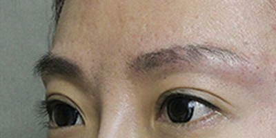 玻尿酸丰眉弓术后
