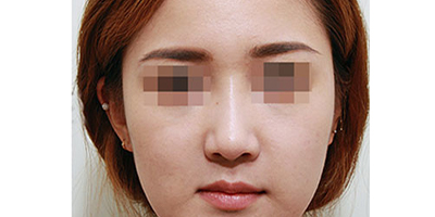 宽鼻矫正术后