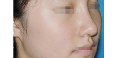 玻尿酸丰鼻基底术后