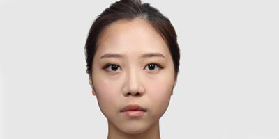 手术缩鼻翼术前