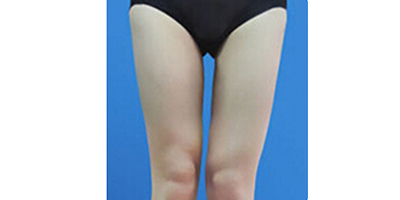 大腿吸脂术后