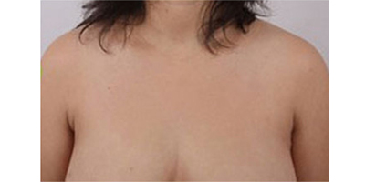 吸脂去副乳术后