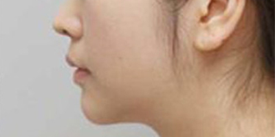 膨体垫下巴术后