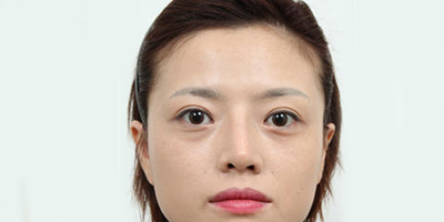 膨体隆鼻术后