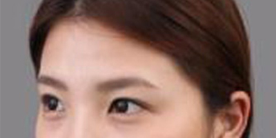 玻尿酸丰额头术前