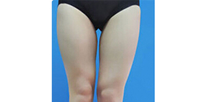 大腿吸脂术前
