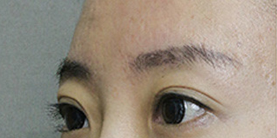 玻尿酸丰眉弓术前