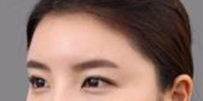 玻尿酸丰额头术后