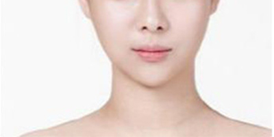 V-LINE瓜子脸手术术后