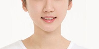 面部吸脂术后