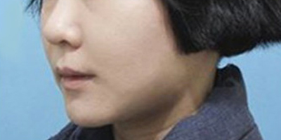 埋线提升术后