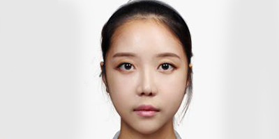手术缩鼻翼术后