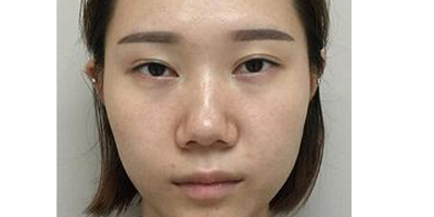 鼻中隔软骨隆鼻术前