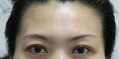 自体脂肪丰太阳穴术前