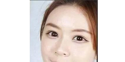 玻尿酸丰卧蚕术后