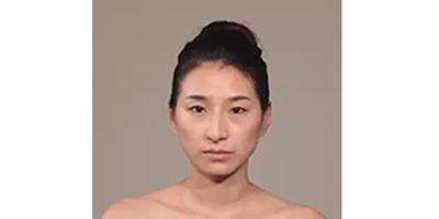 玻尿酸全脸填充术前