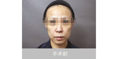自体脂肪存储术前