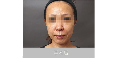 自体脂肪存储术后