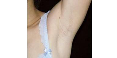 脱腋毛术后