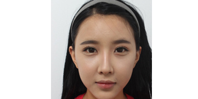 玻尿酸丰面颊术后