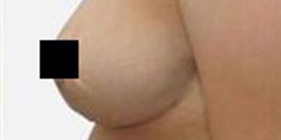 乳房下垂矫正术后
