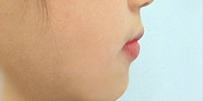 隐形矫正术后