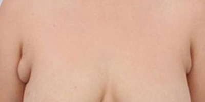 手术去副乳术前