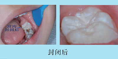 儿童口腔预防窝沟封闭术后