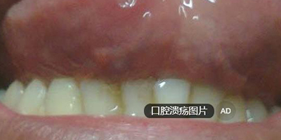 口腔溃疡术后