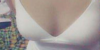 隆胸修复术后