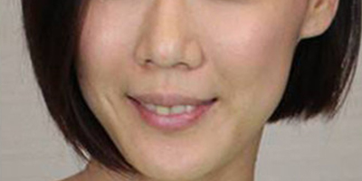 伊肤泉疗程套组术后