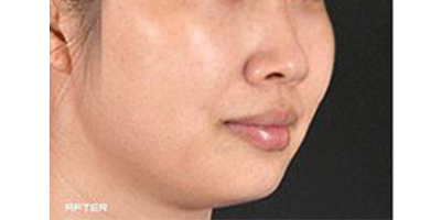 皮秒激光术后