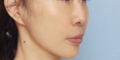 热玛吉术后
