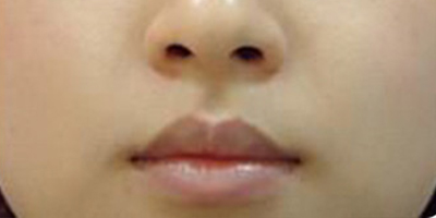 水氧活肤术后