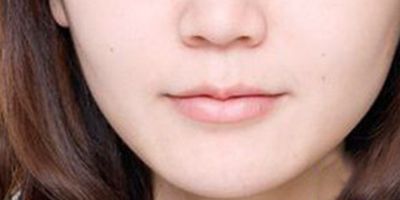 嘴角上扬术术后