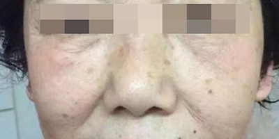 精华导入术后