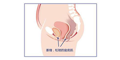 盆底肌修复术前