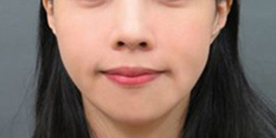 童颜针术后