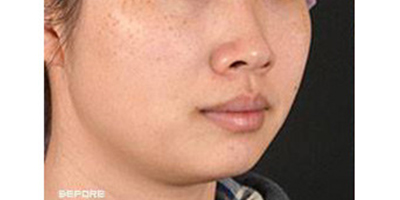 皮秒激光术前
