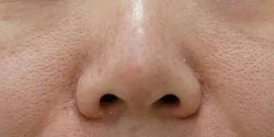 小棕瓶美白术前
