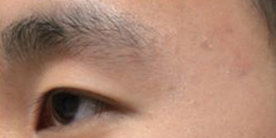 杏仁酸焕肤术后
