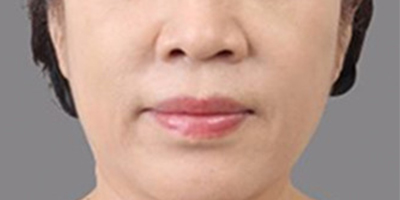 PRP美塑美肤术后