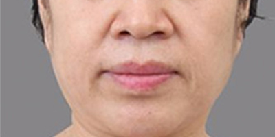 PRP美塑美肤术前