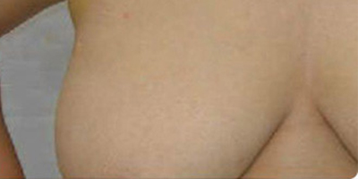 吸脂去副乳术后