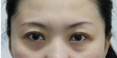 自体脂肪丰太阳穴术后