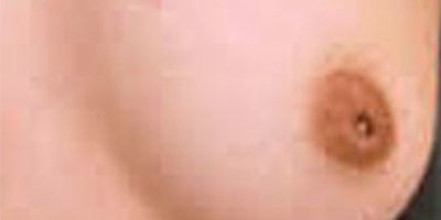 乳头内陷矫正术前