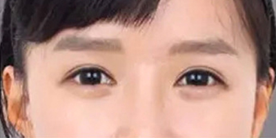 自体脂肪丰卧蚕术后