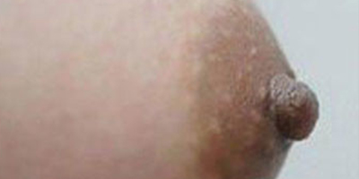 乳头缩小术后