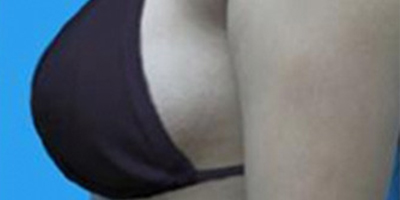自体脂肪隆胸术后