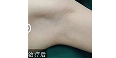 注射去狐臭术后